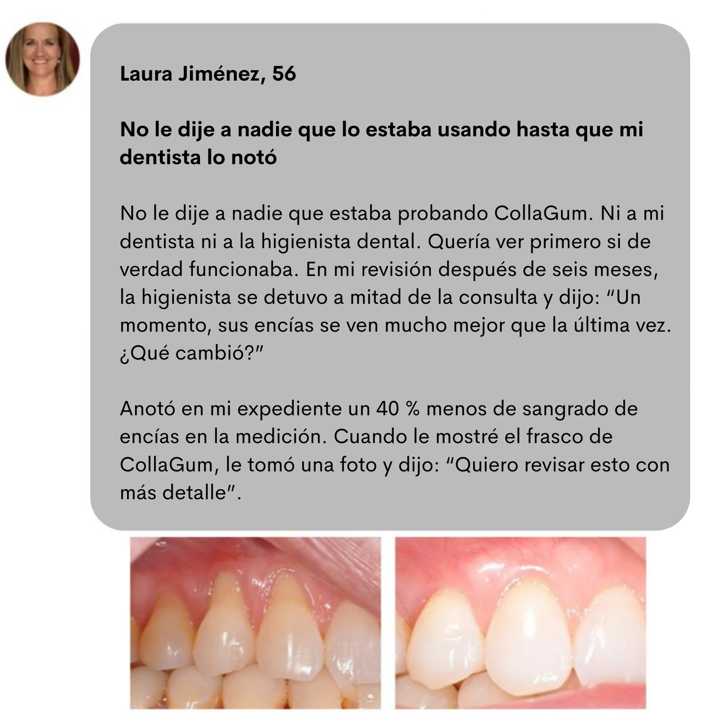 CollaGum™- Colágeno Directo Para Tus Encías