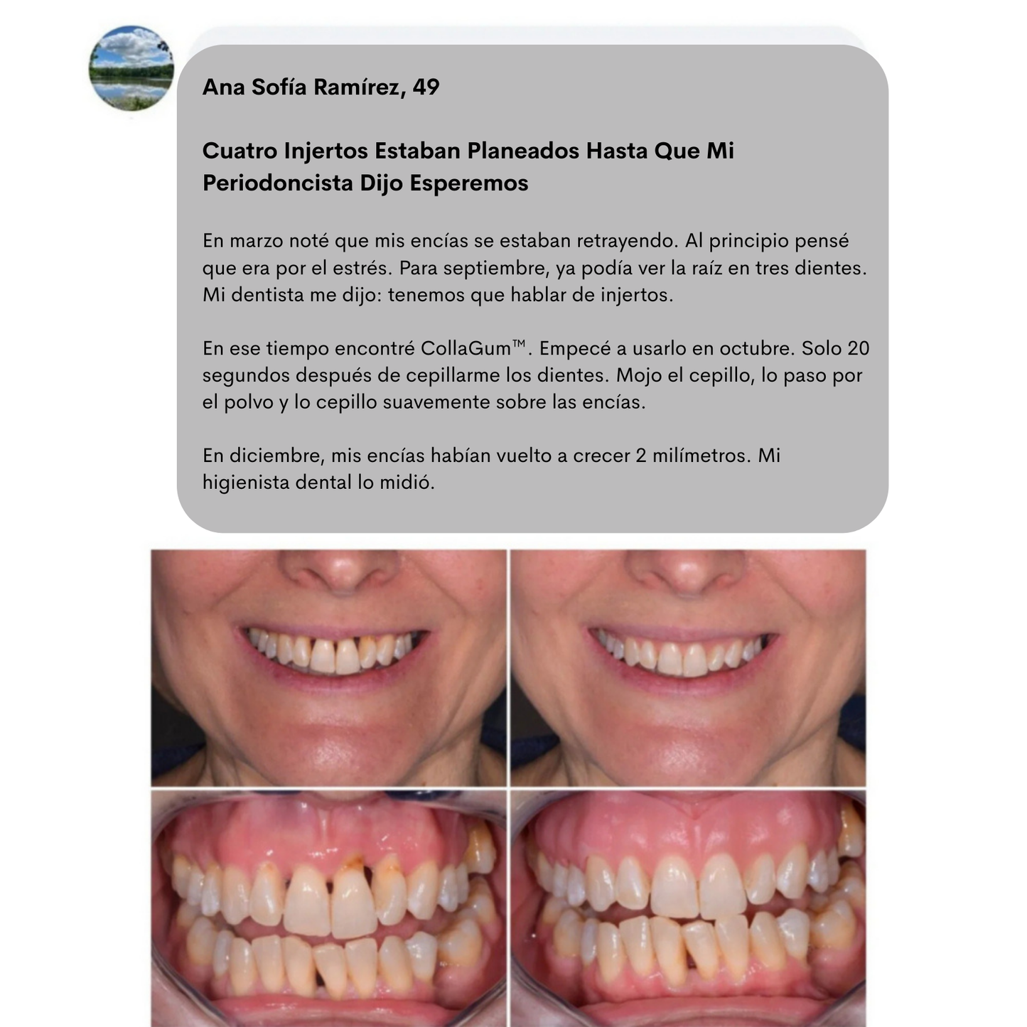 CollaGum™- Colágeno Directo Para Tus Encías