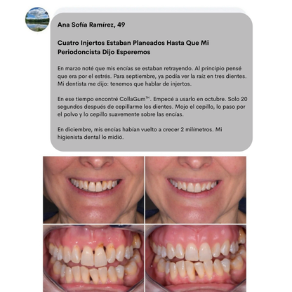 CollaGum™- Colágeno Directo Para Tus Encías