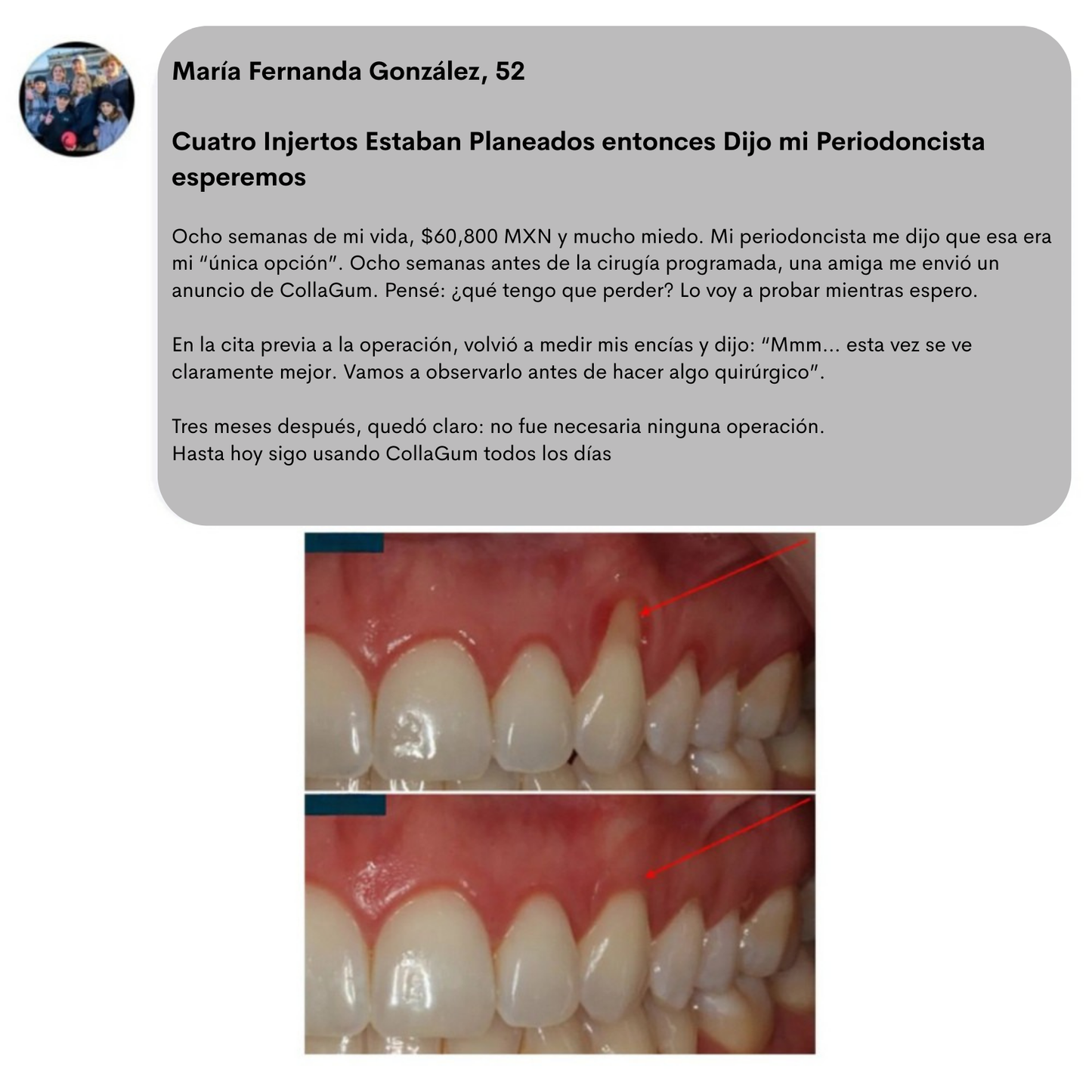 CollaGum™- Colágeno Directo Para Tus Encías